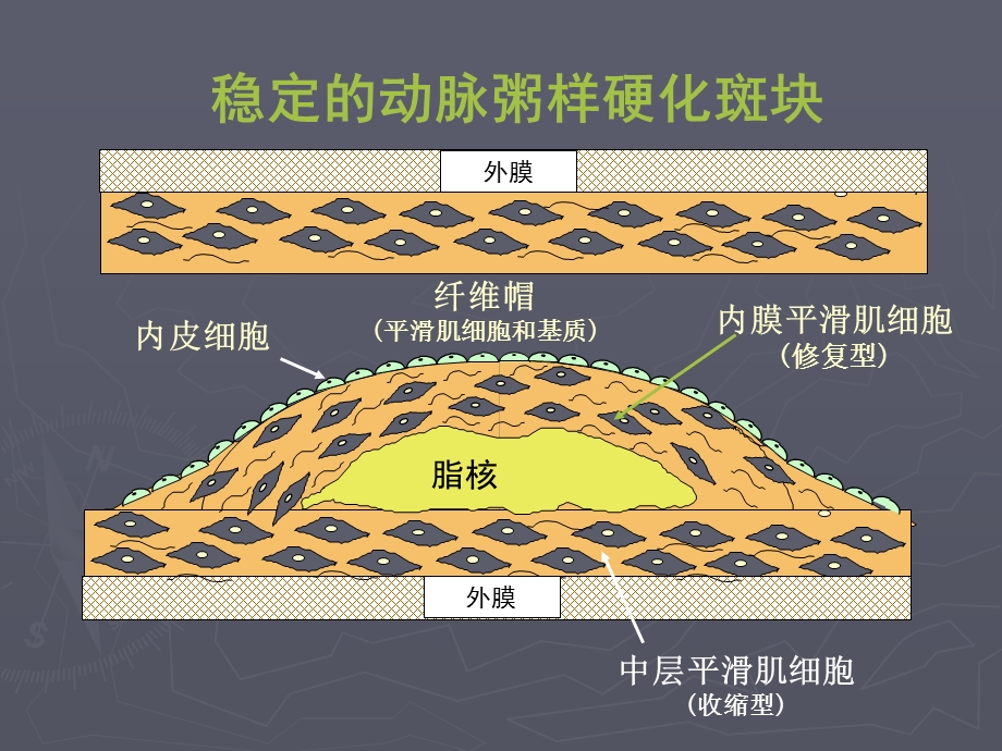 2014稳定性冠心病处理.ppt_第2页