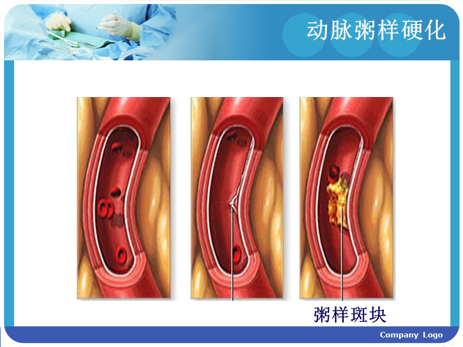 冠心病的护理.ppt_第2页