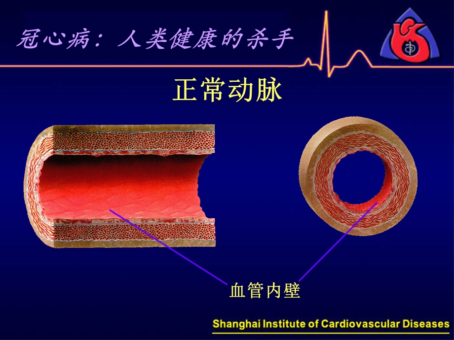 患者教育：冠心病的早期防治.ppt_第3页