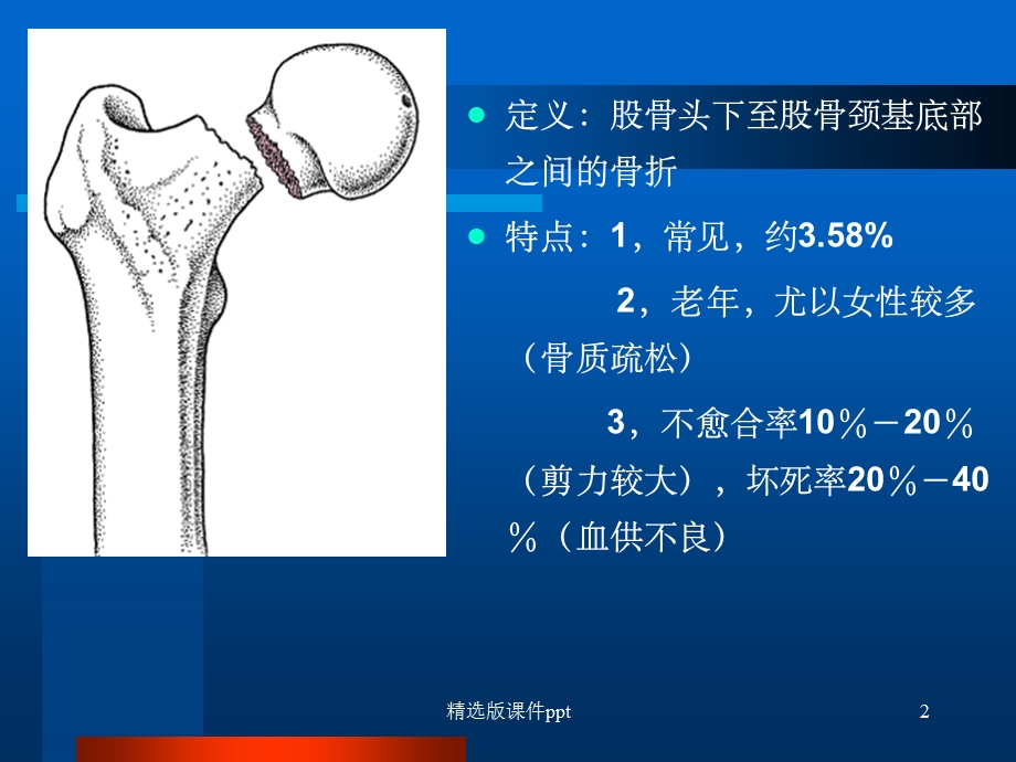 影像学股骨颈骨折.ppt_第2页