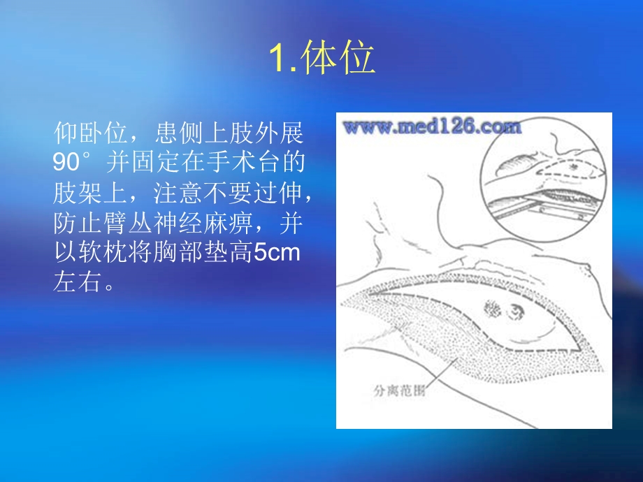 乳腺癌根治术步骤.ppt_第2页