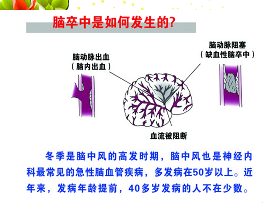 社区脑卒中健康教育.ppt_第3页