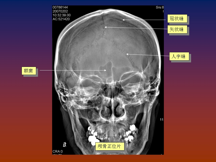 脑血管畸形影像学诊断.ppt_第2页