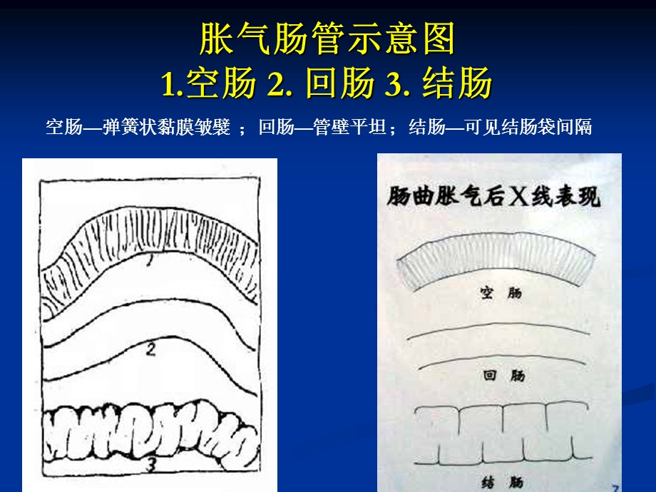 肠梗阻的分类及影像学表现.ppt_第3页