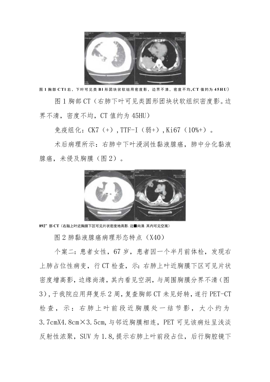 三例肺浸润性黏液腺癌CT诊断分析专题报告.docx_第2页