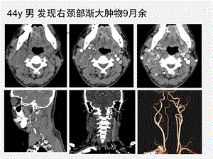 颈动脉体瘤影像学诊断.ppt