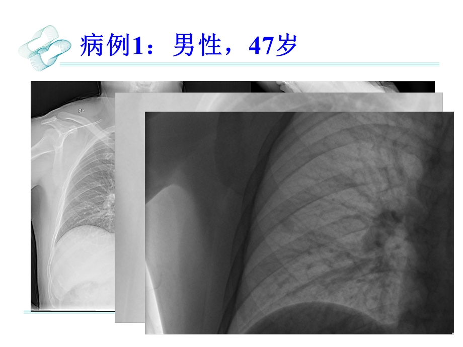 肺硬化性血管瘤影像学诊断.ppt_第1页