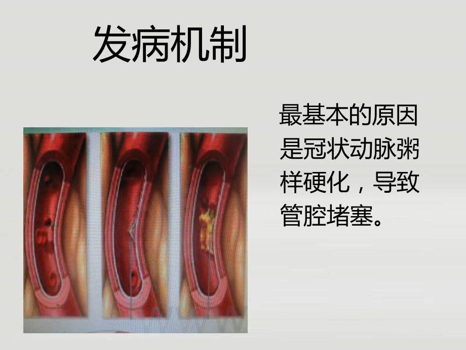 冠心病护理常规.ppt_第3页