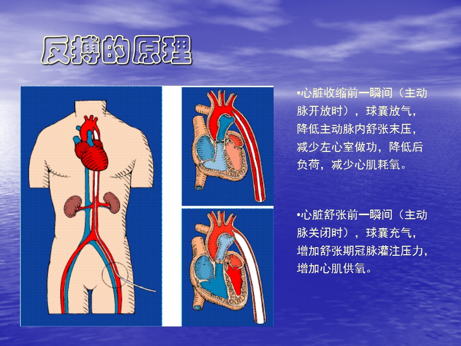 IABP临床应用.ppt_第3页