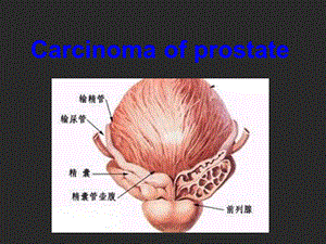 前列腺癌英文版精品医学课件.ppt