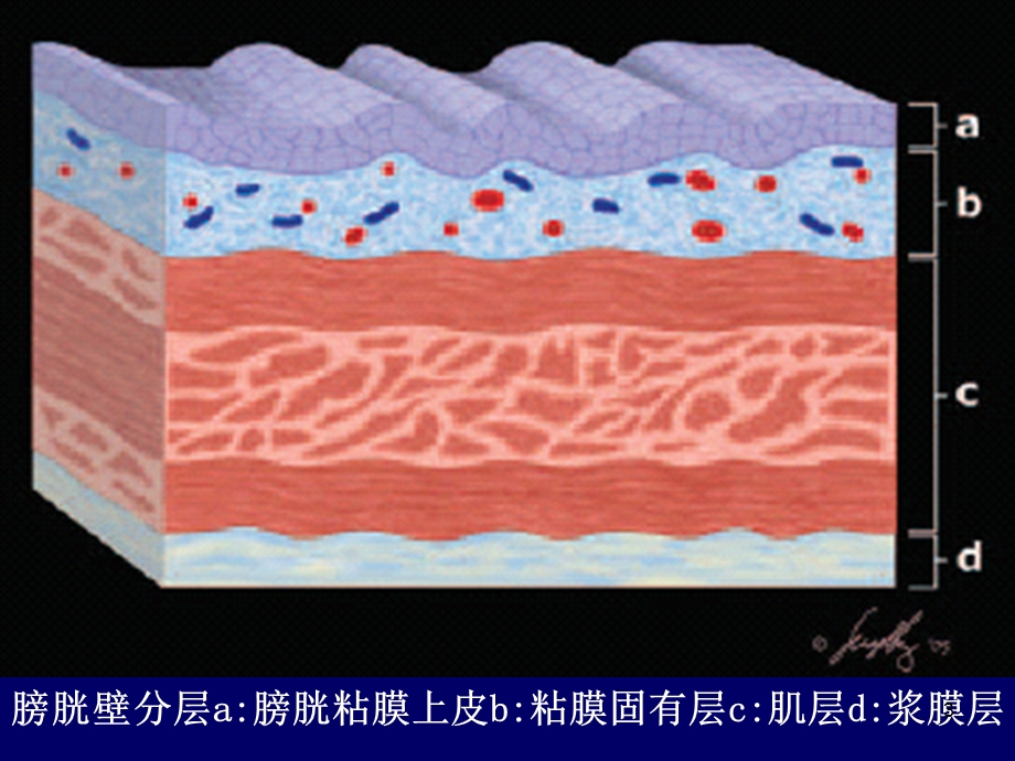 膀胱肿瘤影像诊断医学PPT课件.ppt_第3页