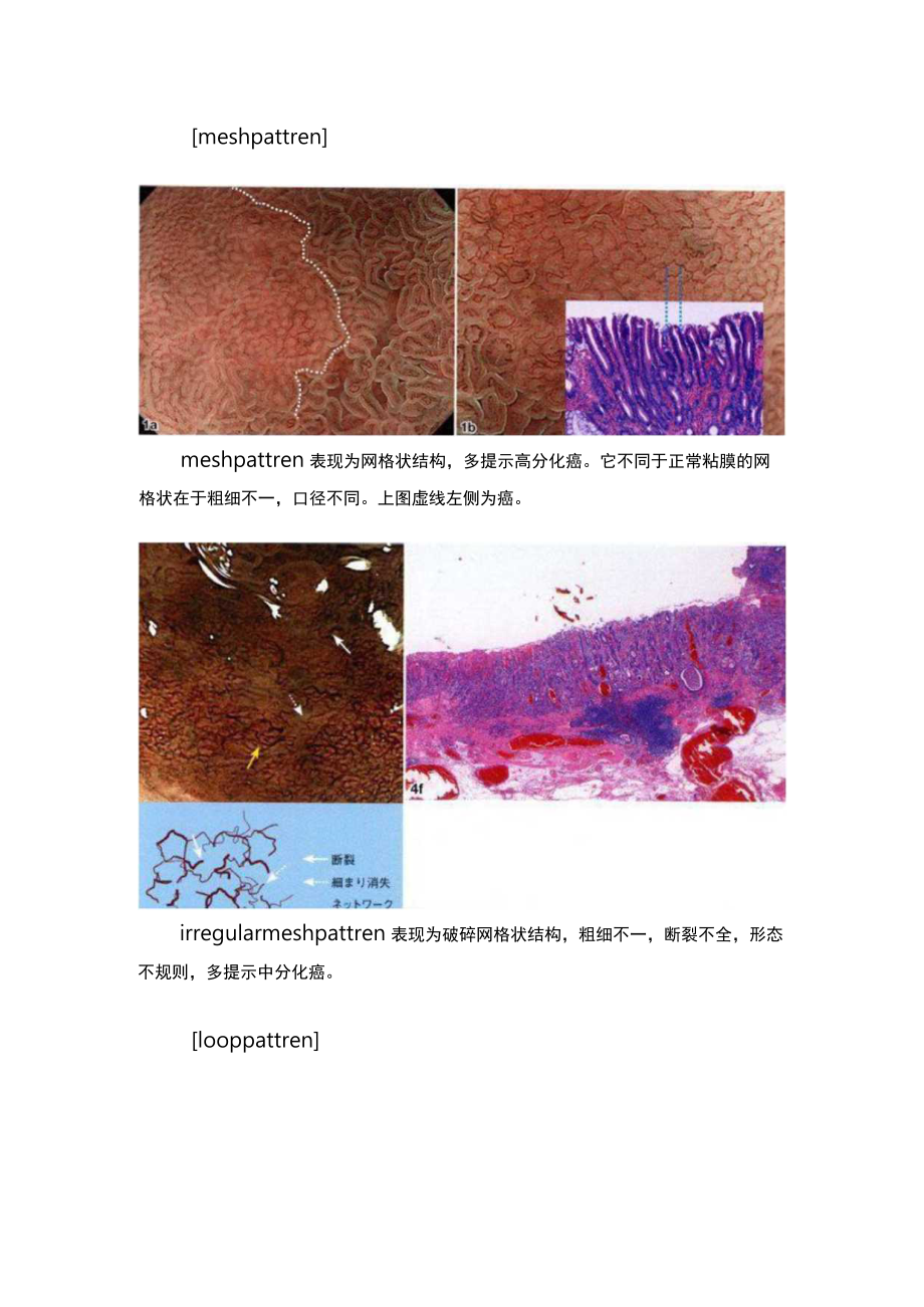 医学美图：八木胃早癌理论（分化癌）.docx_第2页