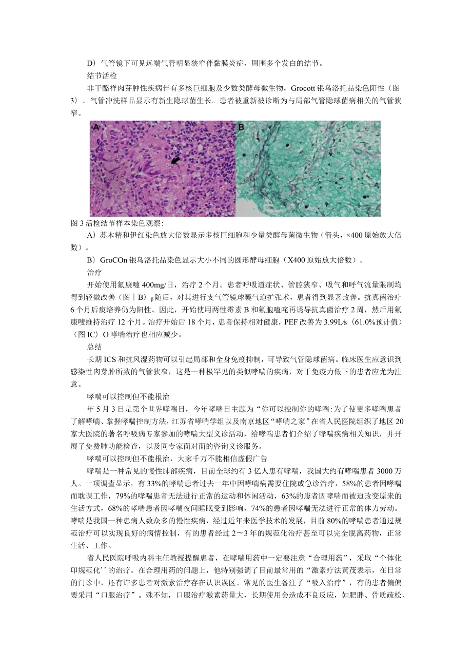 59岁女性患哮喘14年最近症状不能控制真实原因并不简单（附哮喘可以控制但不能根治）.docx_第2页