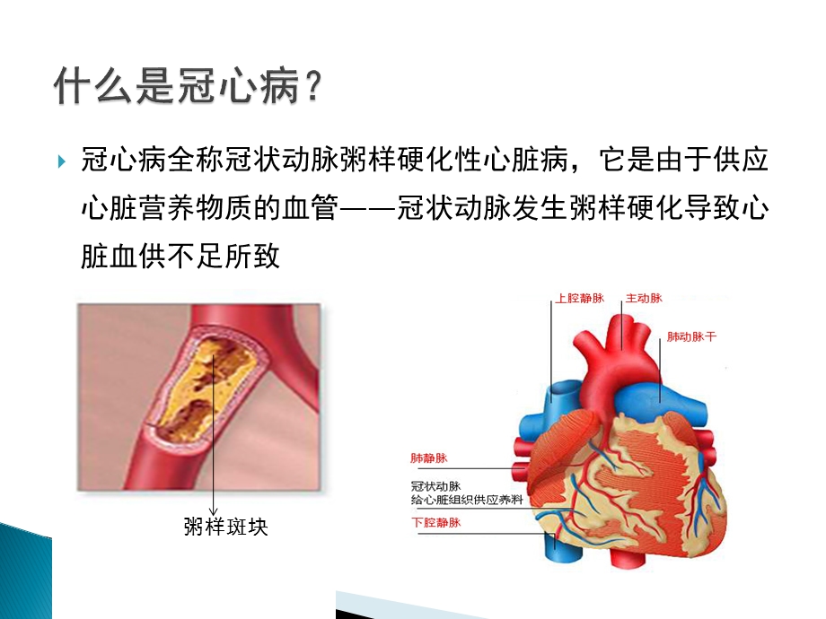 冠心病的介入治疗.pptx_第3页