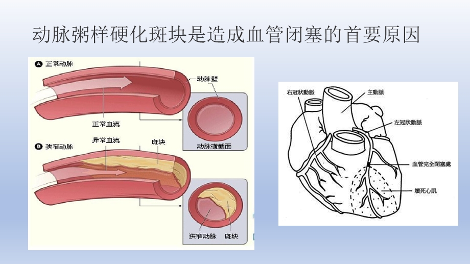 冠心病健康教育.pptx_第3页