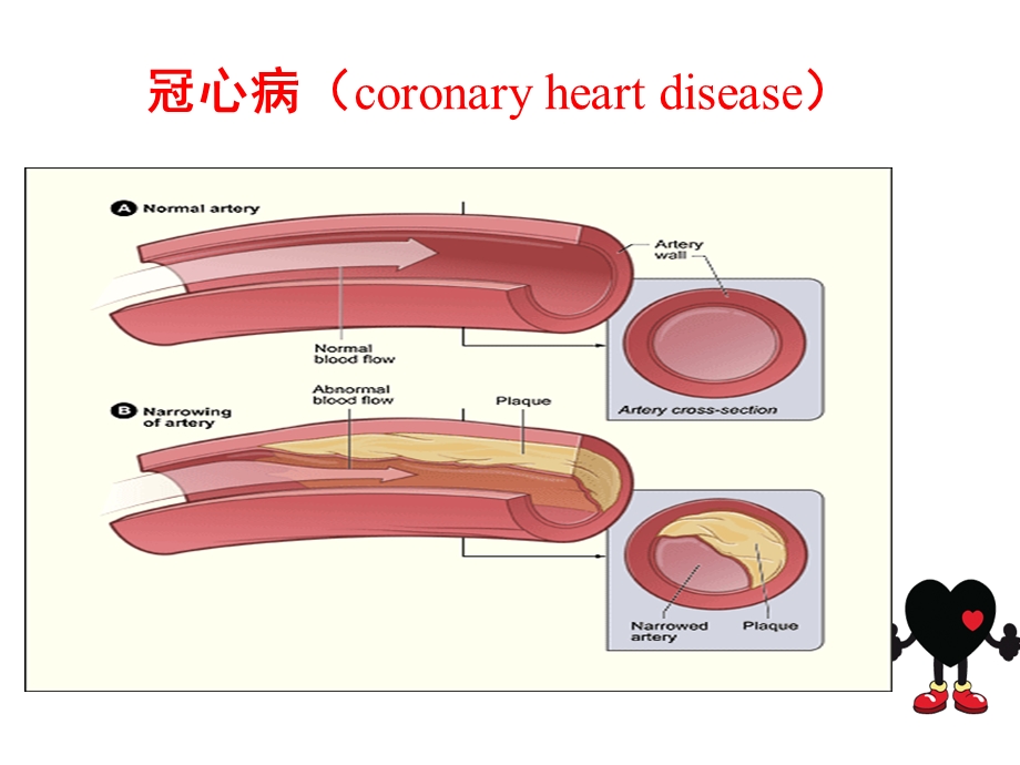 冠心病患者行非心脏手术的麻醉管理.pptx_第3页