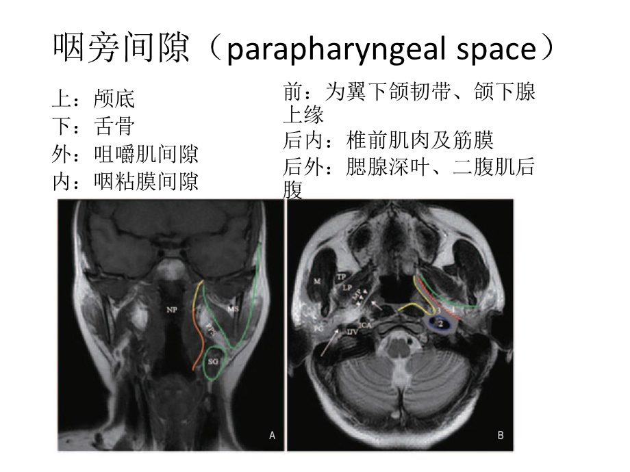 咽旁肿瘤的影像学诊断.pptx_第2页