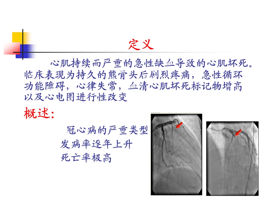 心肌梗死课件.pptx_第3页