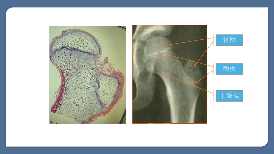 骨骺损伤的影像学表现.pptx_第3页