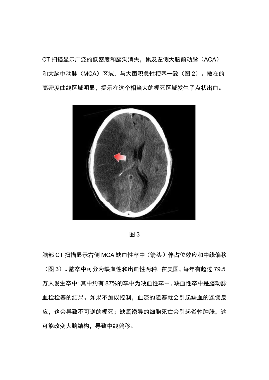 最新：急性卒中的关键诊断（附图）.docx_第2页