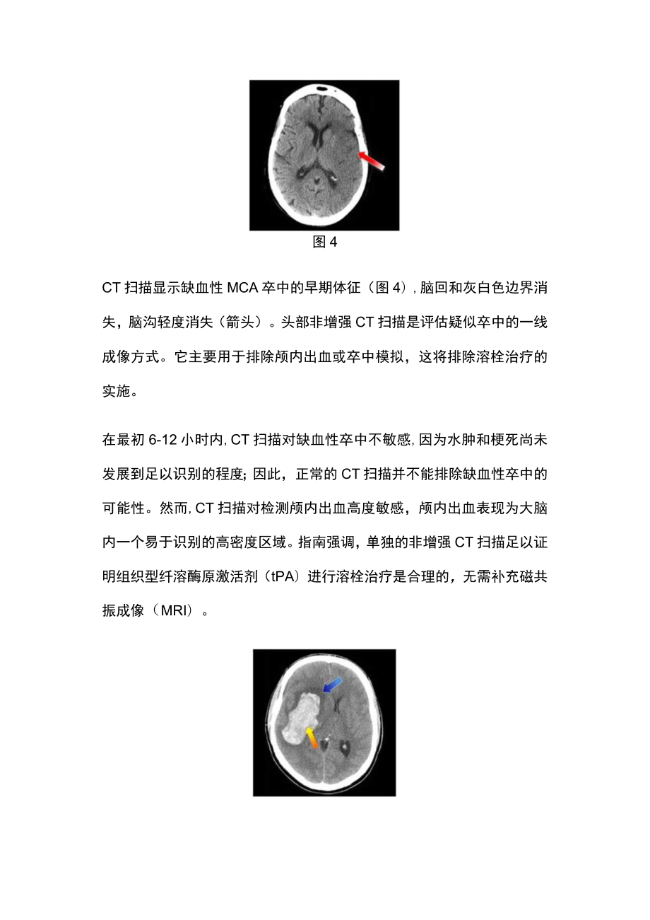 最新：急性卒中的关键诊断（附图）.docx_第3页