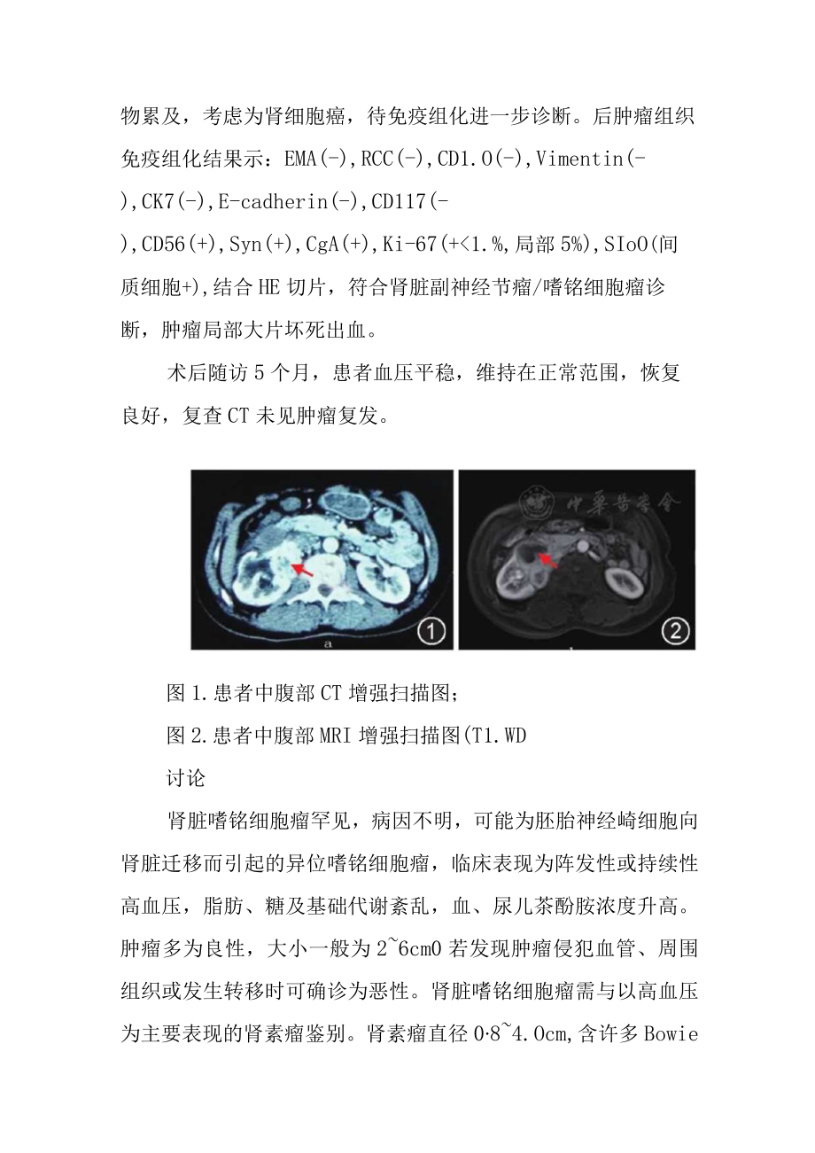 泌尿外科医师晋升副主任（主任）医师高级职称病例分析专题报告（肾脏嗜铬细胞瘤病例报告）.docx_第3页