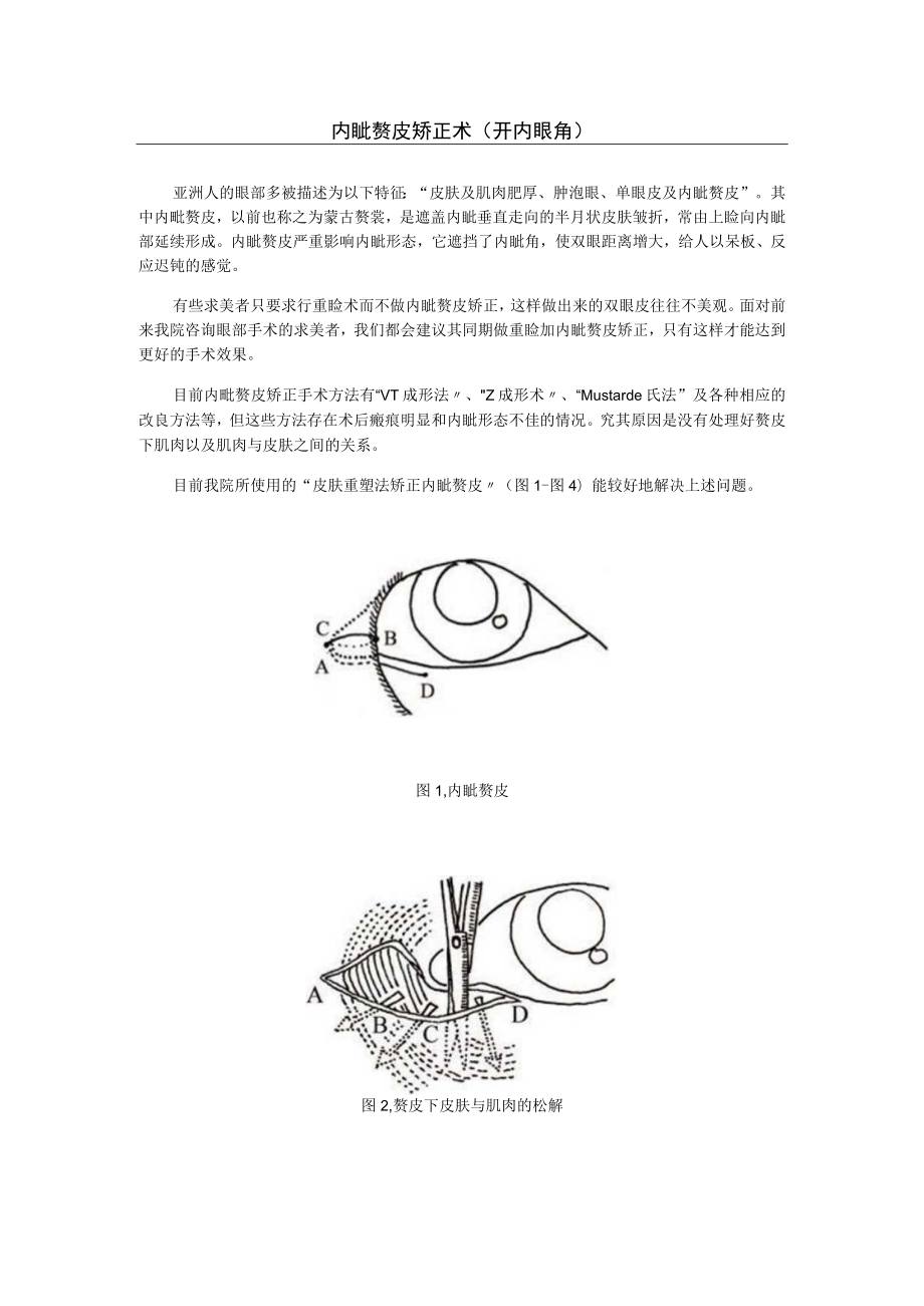 医美眼整形内眦赘皮基础知识.docx_第2页