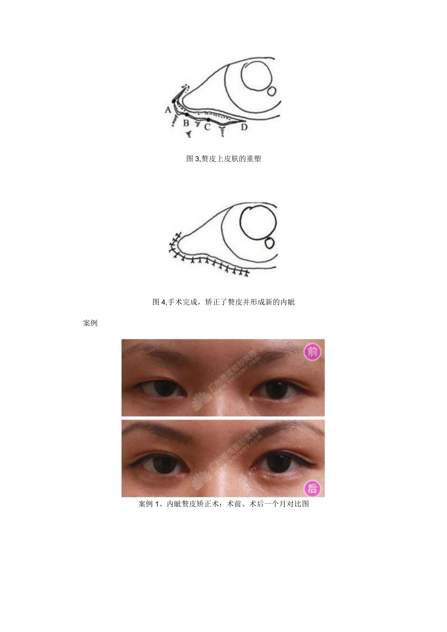 医美眼整形内眦赘皮基础知识.docx_第3页