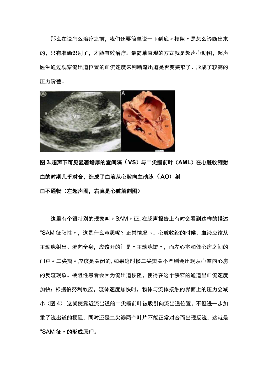 2023梗阻性肥厚型心肌病诊疗方法汇总（全文）.docx_第3页