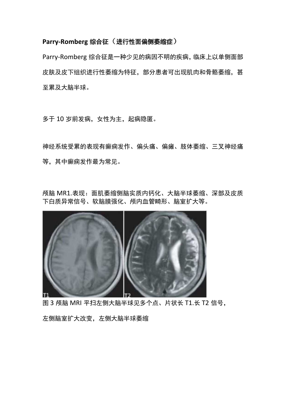 2022影像学表现为一侧脑萎缩的疾病（全文）.docx_第3页