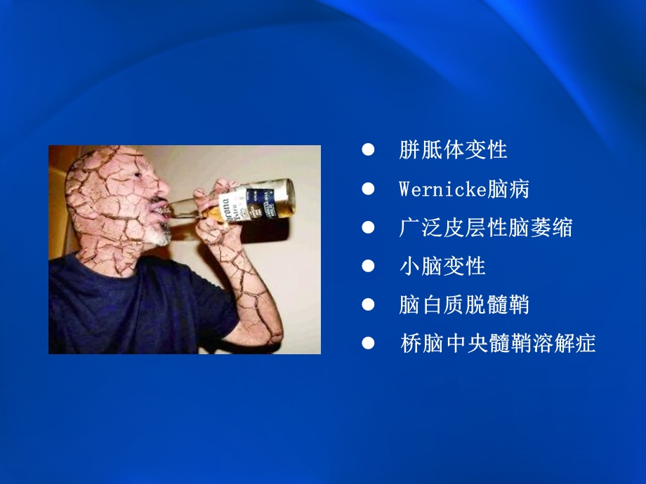 酒精中毒性脑病影像学表现.pptx_第2页