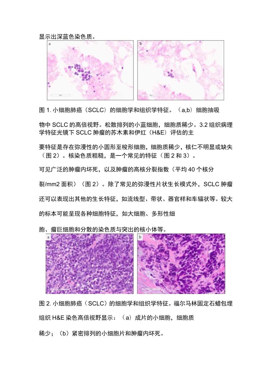 2023小细胞肺癌病理诊断要点.docx_第3页