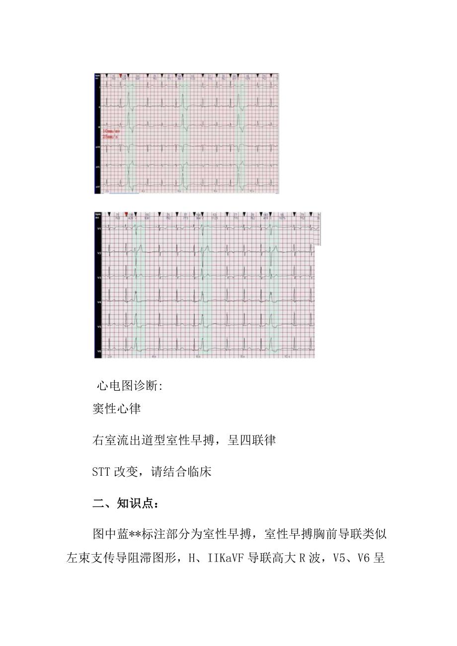 心电图病例分析：右室流出道型室性早搏病例分析专题报告.docx_第2页