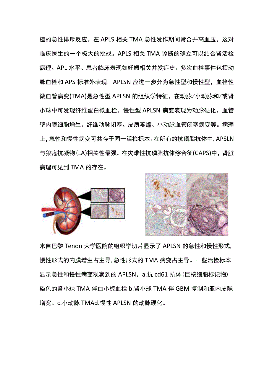 2023抗磷脂抗体综合征肾病：病理生理学和管理.docx_第3页