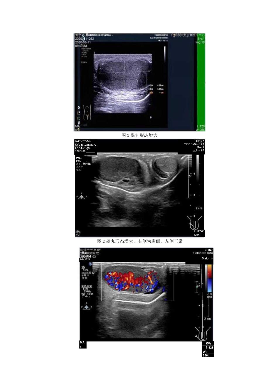 高频彩超在小儿睾丸白血病诊断中的应用.docx_第3页