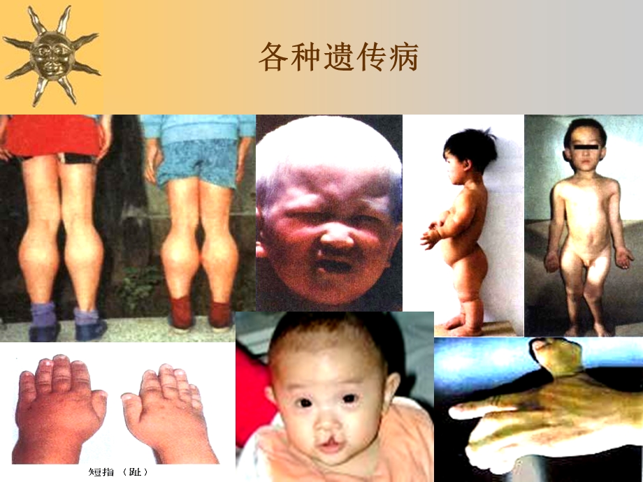 遗传病和遗传病的预防.ppt_第1页