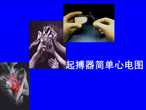 起搏器心电图1.ppt