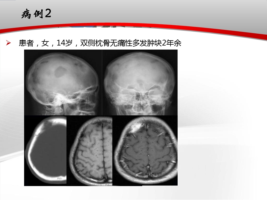 颅骨肿瘤影像学表现.ppt_第3页