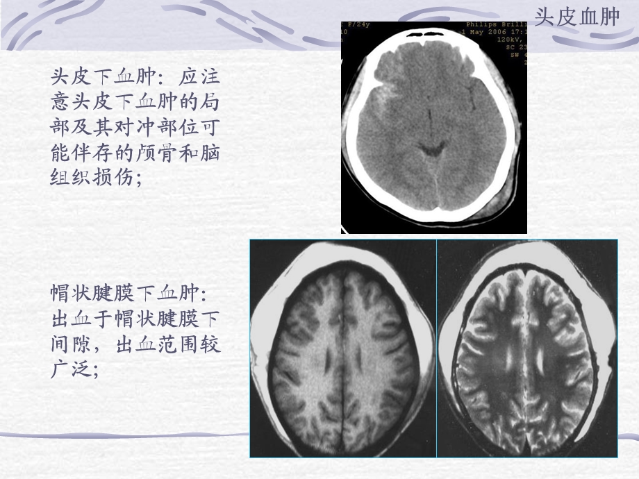 颅脑外伤CT.ppt_第3页