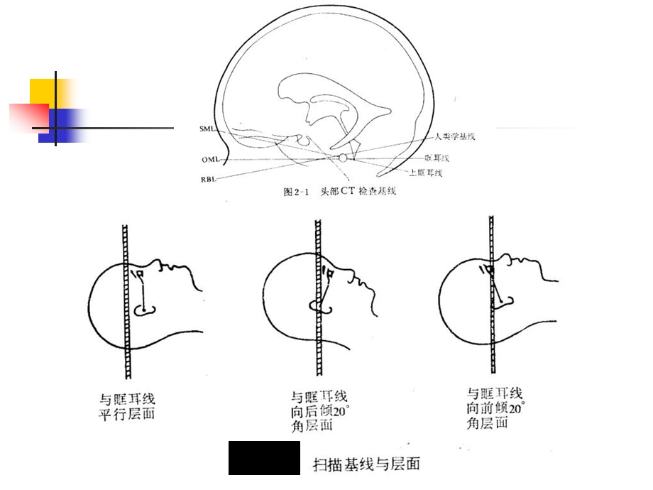 颅脑CT诊断1.ppt_第3页