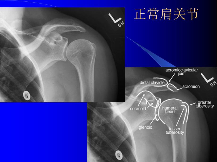 骨科常见疾病的X线表现.ppt_第2页