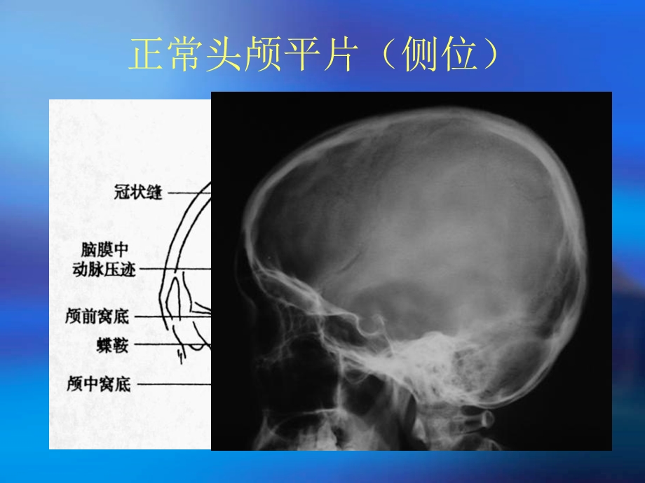 颅骨x线诊断.ppt_第1页