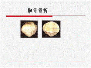 髌骨骨折康复.ppt