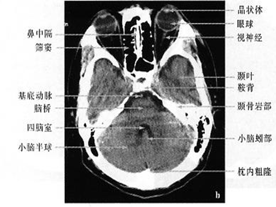 颅脑CTMRI解剖3.ppt_第3页