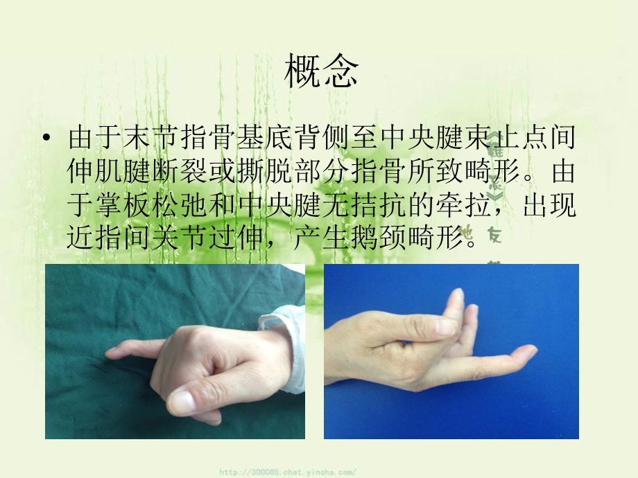 锤状指的保守治疗.ppt_第3页