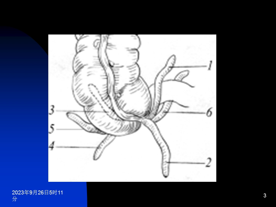 阑尾炎中文课件.ppt_第3页
