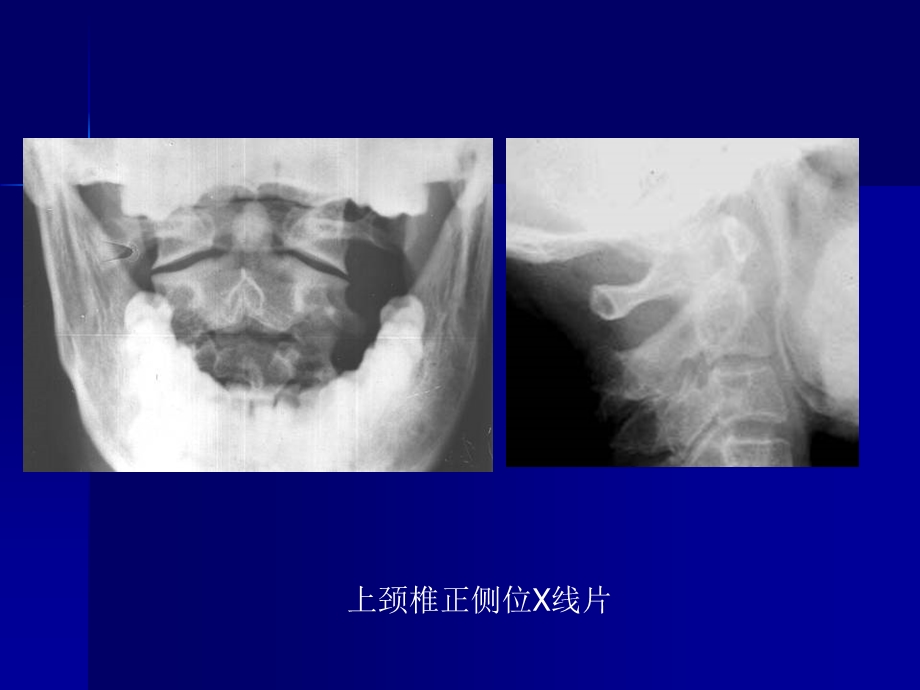 脊柱外科影像学检查.ppt_第3页