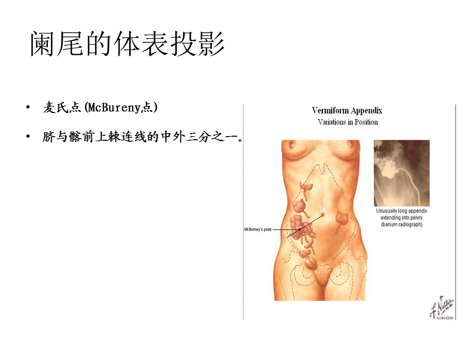 第三节急性阑尾炎病人的护理.ppt_第3页