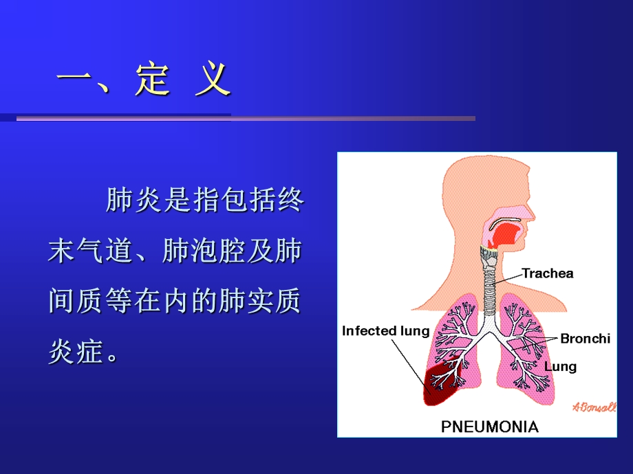 肺炎新世纪版.ppt_第3页