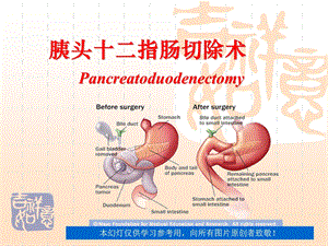 胰十二指肠切除术.ppt